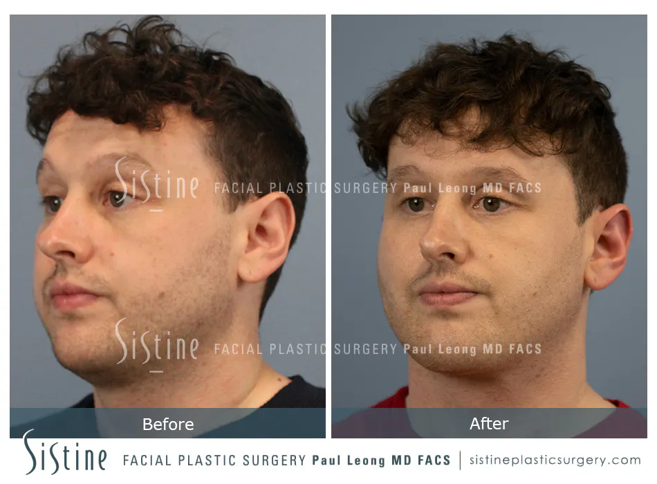 Pittsburgh High SMAS Facelift - Preoperative Left Later Chin Tucked View  Sistine Facial Plastic Surgery