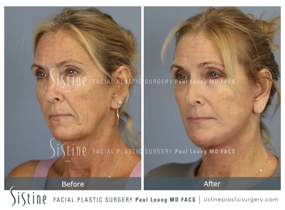 Pittsburgh Face and Neck Lift - Preoperative Left Oblique View | Dr. Paul Leong