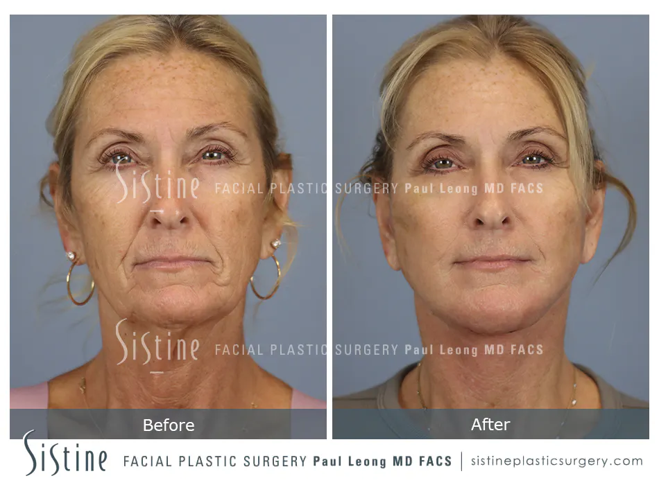 Pittsburgh Face and Neck Lift - Preoperative Left Oblique View | Dr. Paul Leong