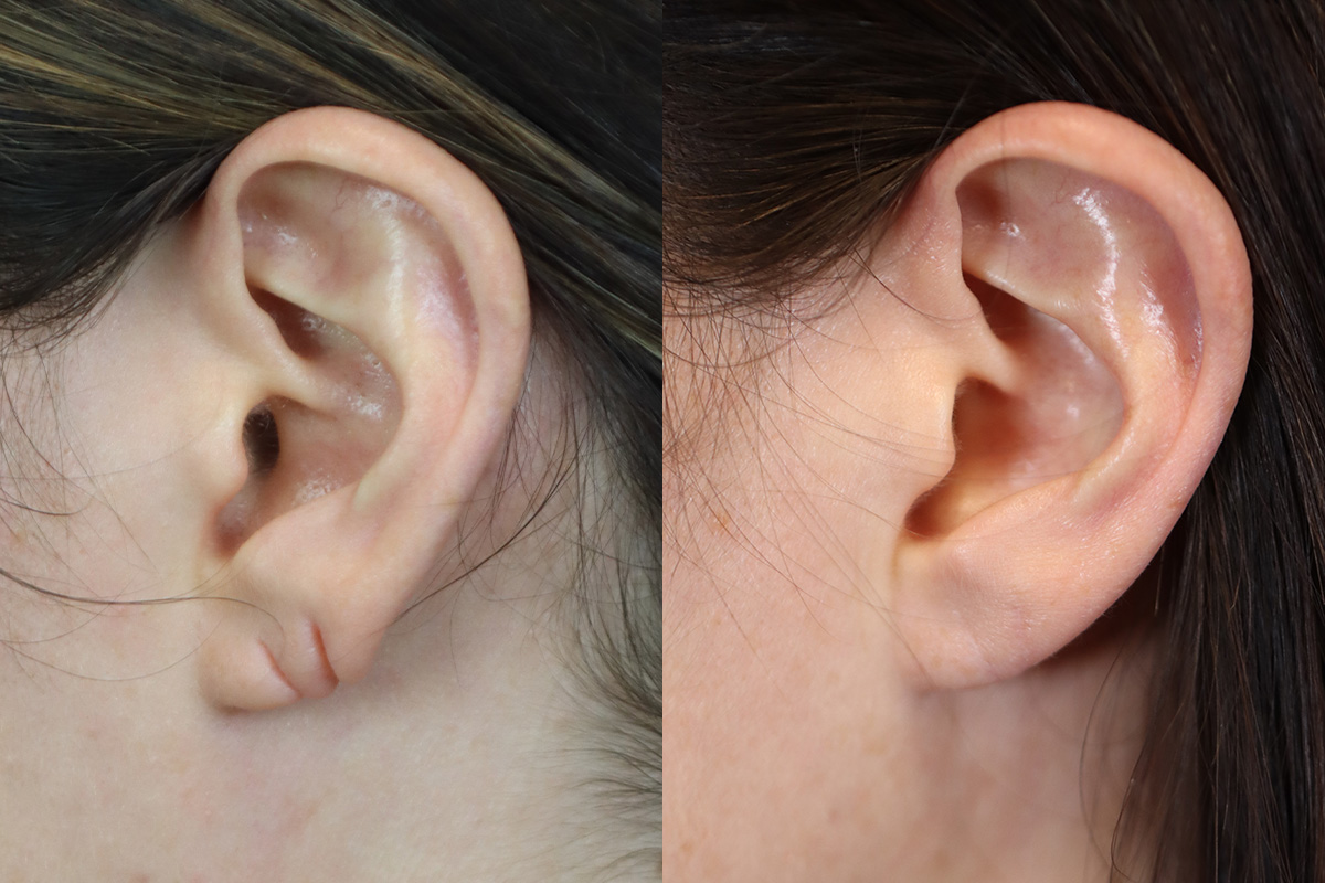 Earlobe Repair Before and After | Leong Facial Plastic Surgery