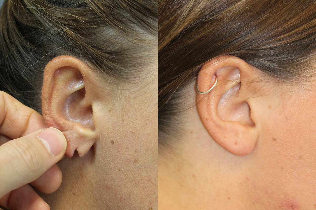 Earlobe Repair Before and After | Leong Facial Plastic Surgery