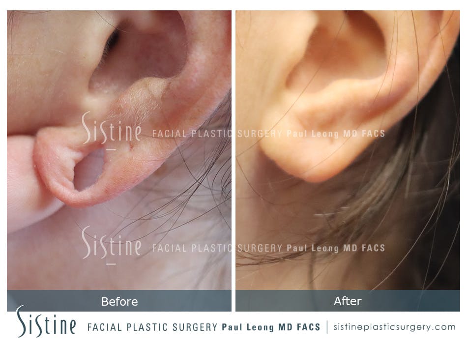 Earlobe Repair Before and After | Leong Facial Plastic Surgery
