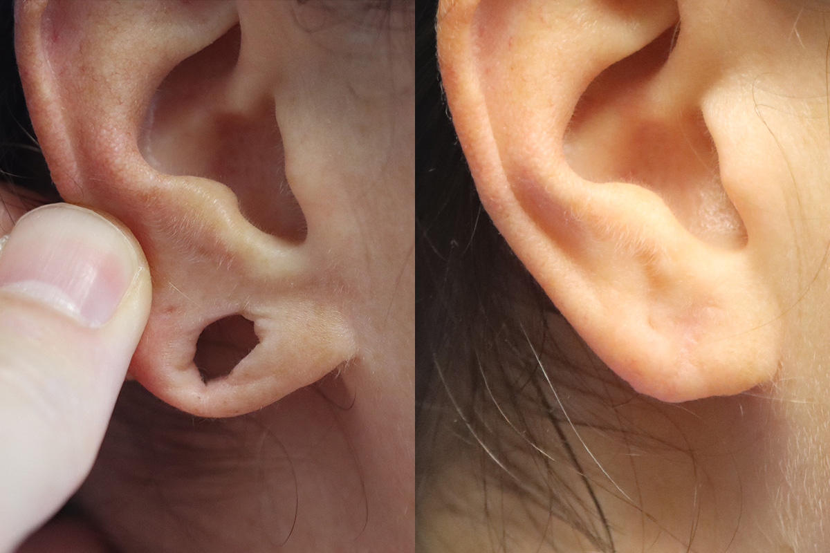 Earlobe Repair Before and After | Leong Facial Plastic Surgery
