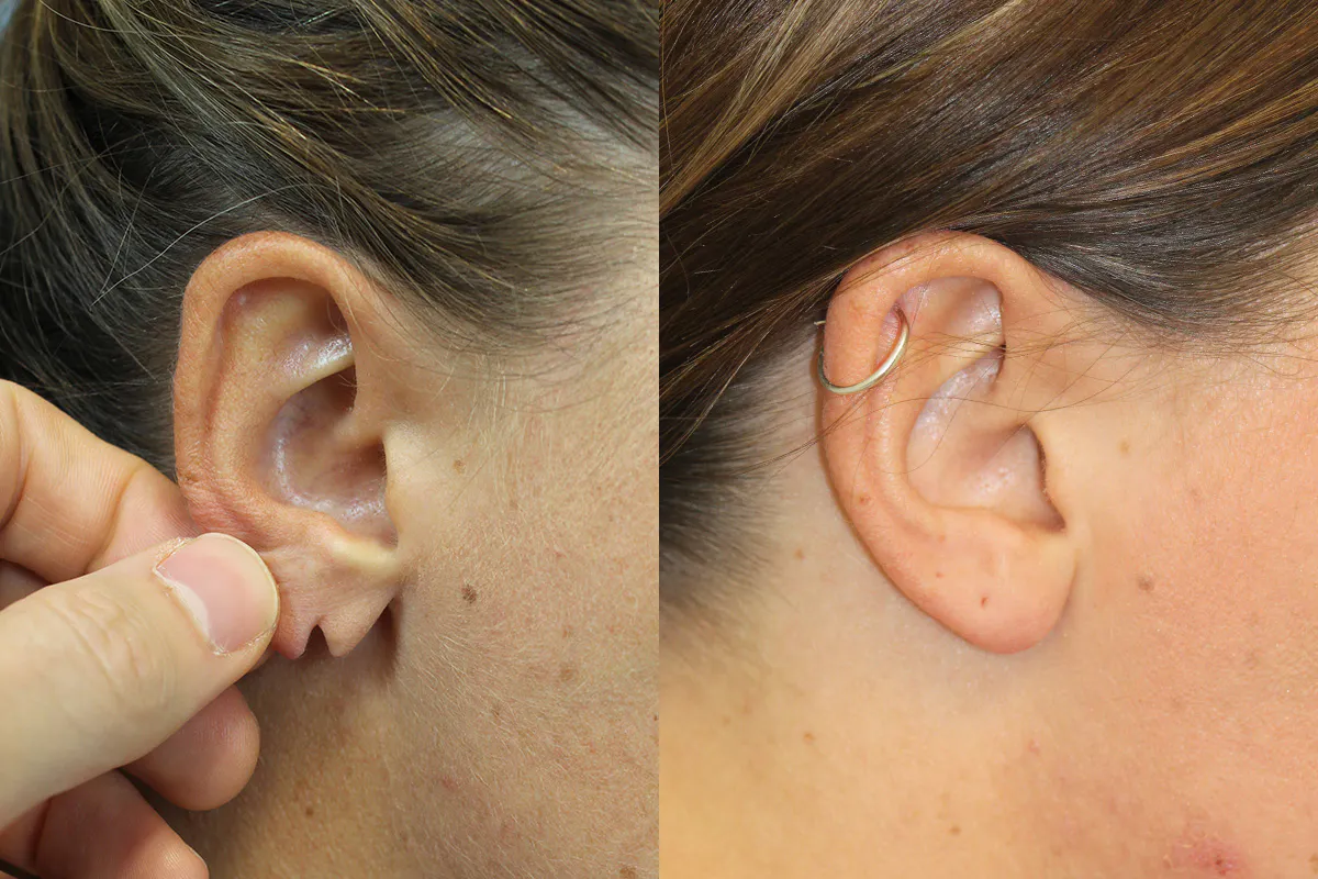 Earlobe Repair Before and After | Leong Facial Plastic Surgery