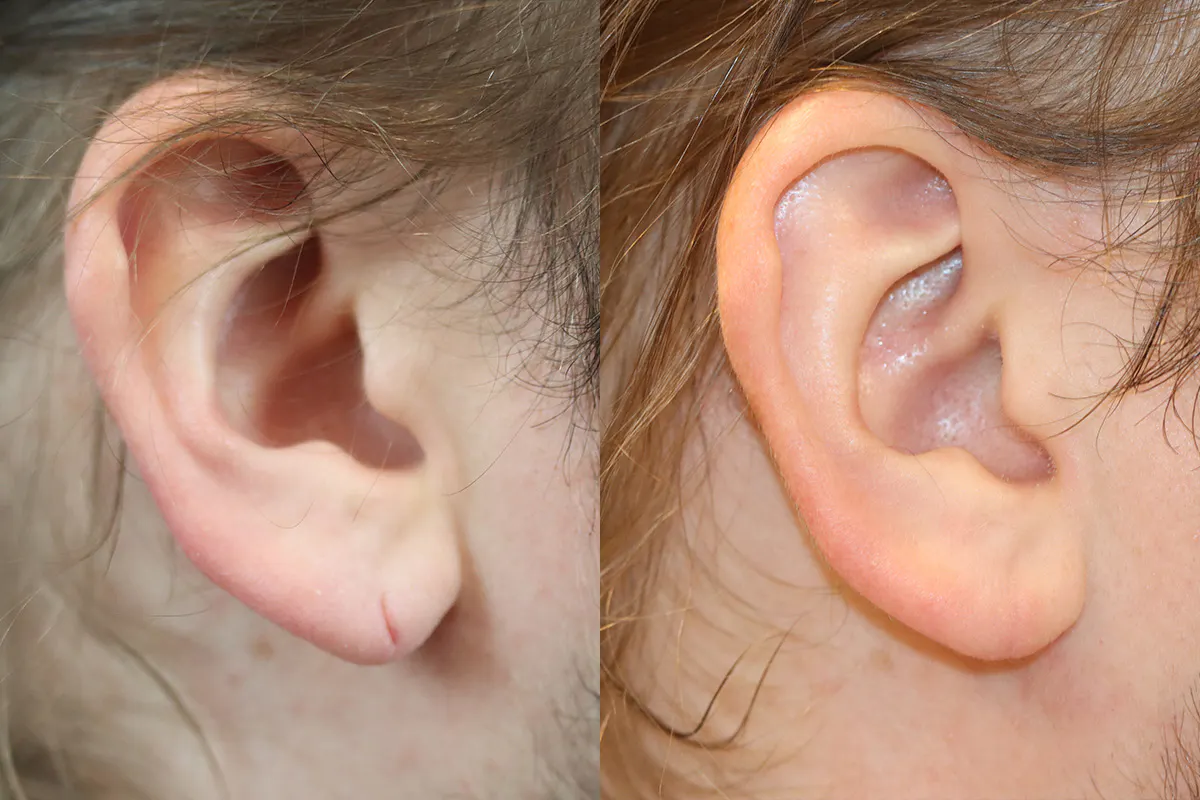 Earlobe Repair Before and After | Leong Facial Plastic Surgery