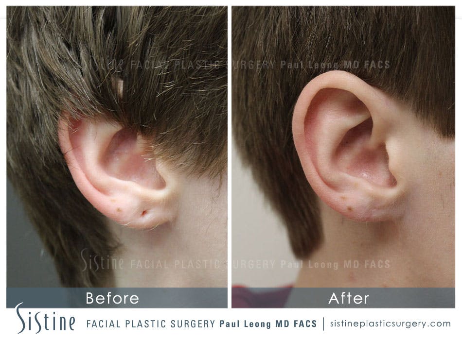 Earlobe Repair Before and After | Leong Facial Plastic Surgery