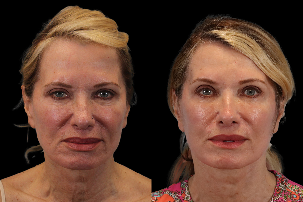 Facelift Before and After | Leong Facial Plastic Surgery