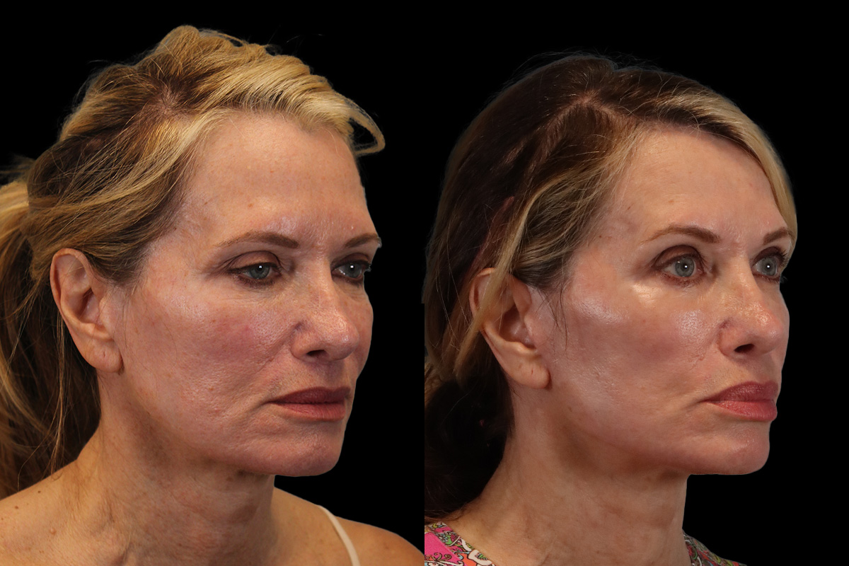 Facelift Before and After | Leong Facial Plastic Surgery