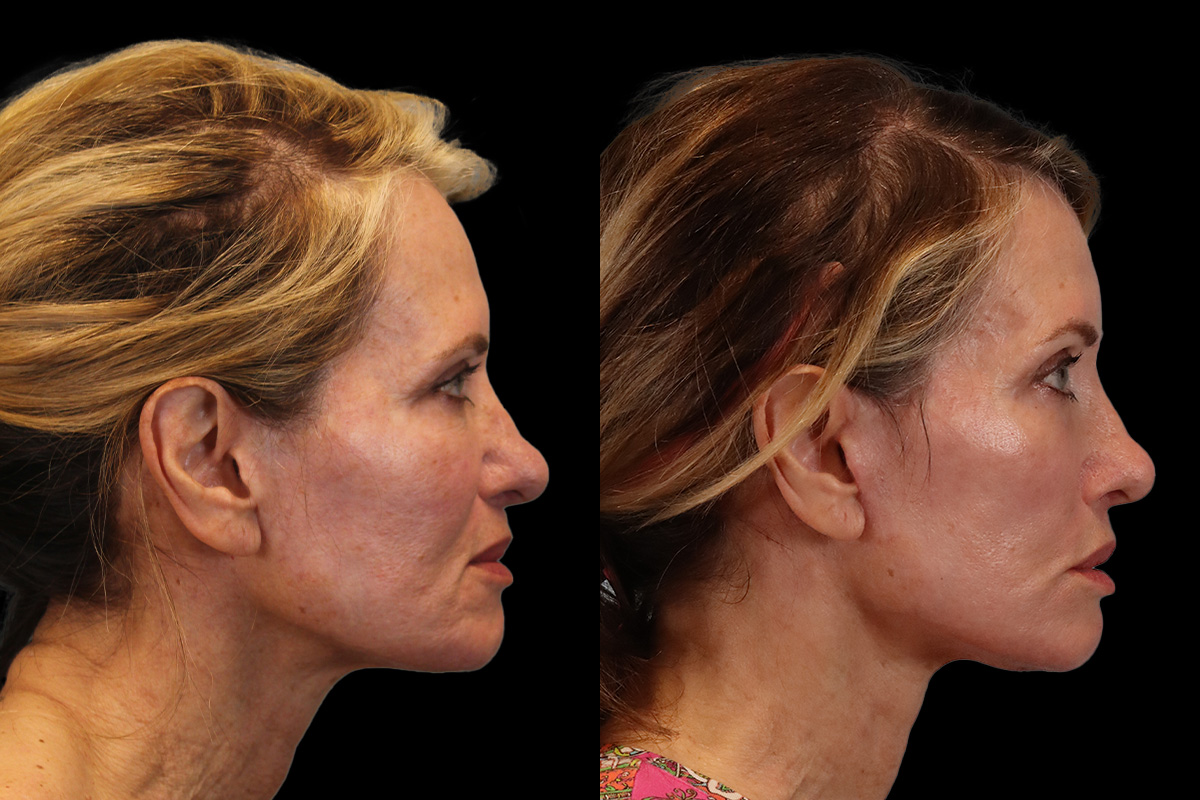 Facelift Before and After | Leong Facial Plastic Surgery