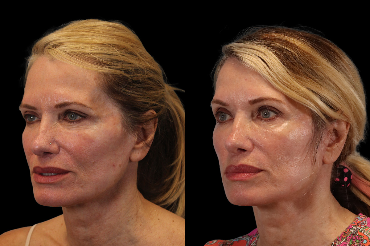 Facelift Before and After | Leong Facial Plastic Surgery