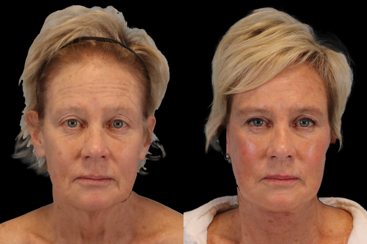 Facelift Before and After | Leong Facial Plastic Surgery