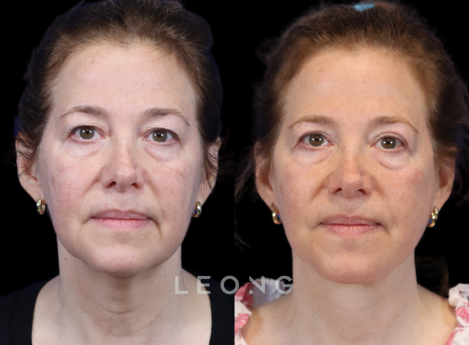 Facelift Before and After | Leong Facial Plastic Surgery