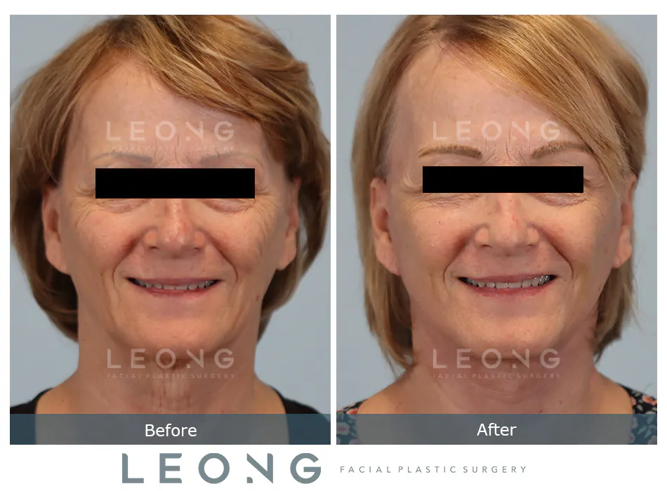 Facelift Before and After | Leong Facial Plastic Surgery