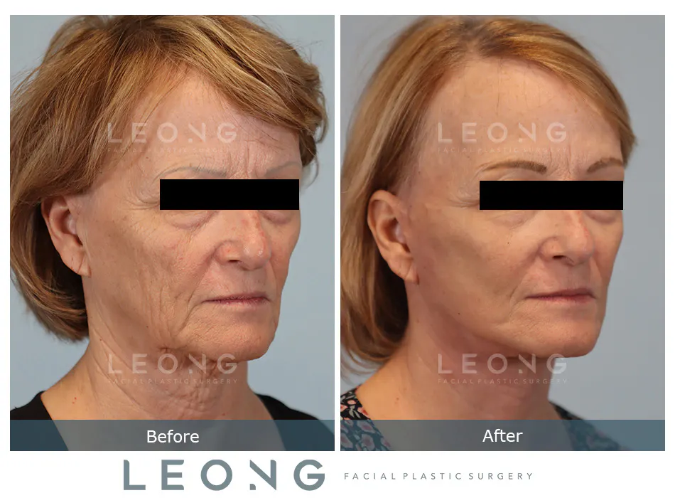 Facelift Before and After | Leong Facial Plastic Surgery