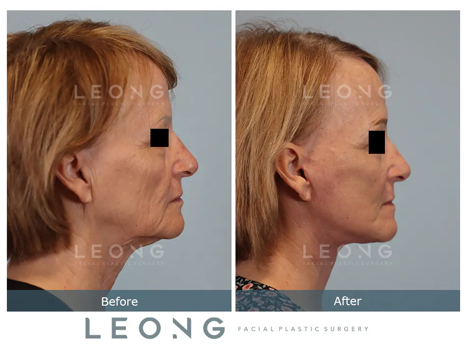 Facelift Before and After | Leong Facial Plastic Surgery