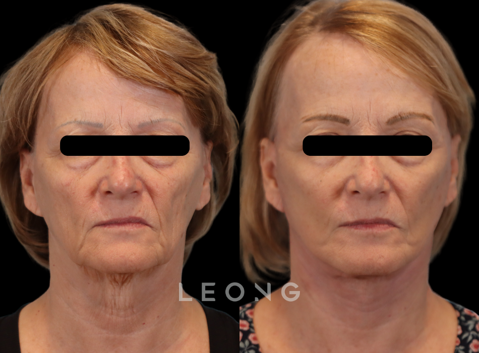 Facelift Before and After | Leong Facial Plastic Surgery