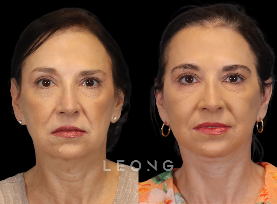 Facelift Before and After | Leong Facial Plastic Surgery