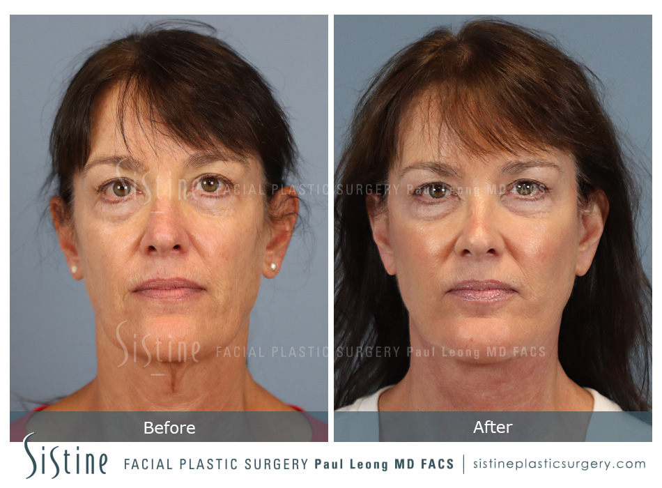 Facelift Before and After | Leong Facial Plastic Surgery