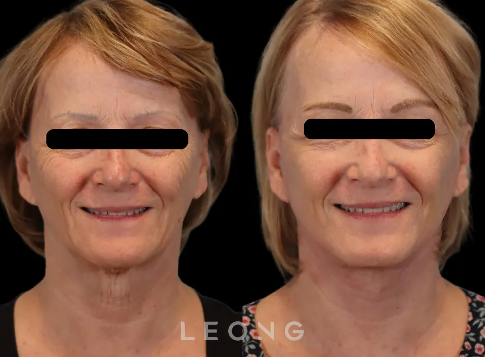 Facelift Before and After | Leong Facial Plastic Surgery