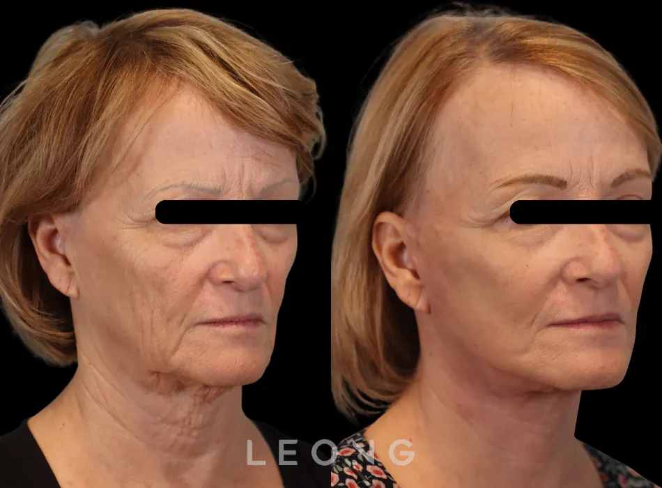 Facelift Before and After | Leong Facial Plastic Surgery
