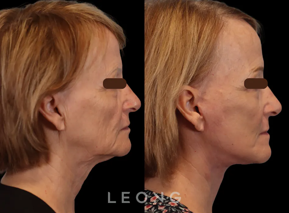 Facelift Before and After | Leong Facial Plastic Surgery