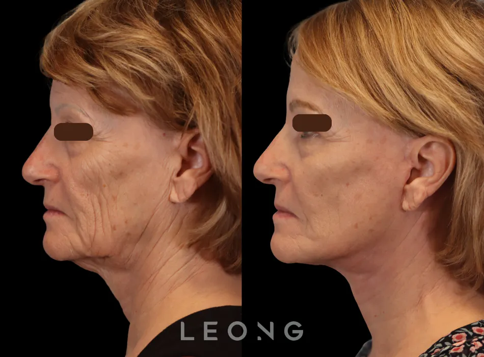 Facelift Before and After | Leong Facial Plastic Surgery