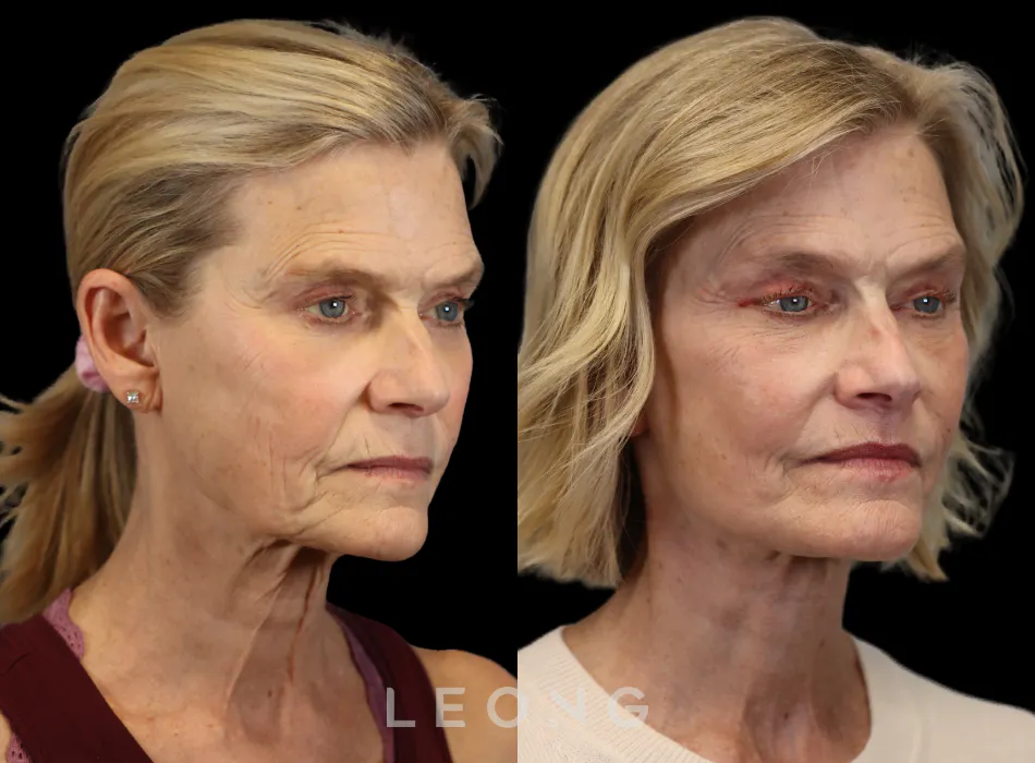 Facelift Before and After | Leong Facial Plastic Surgery