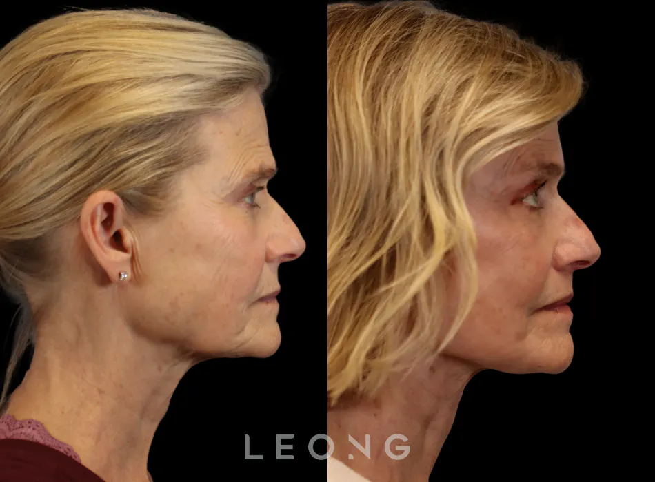 Facelift Before and After | Leong Facial Plastic Surgery