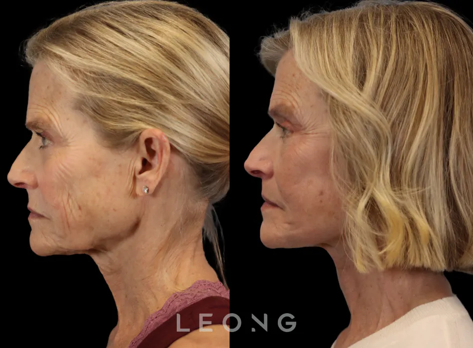 Facelift Before and After | Leong Facial Plastic Surgery