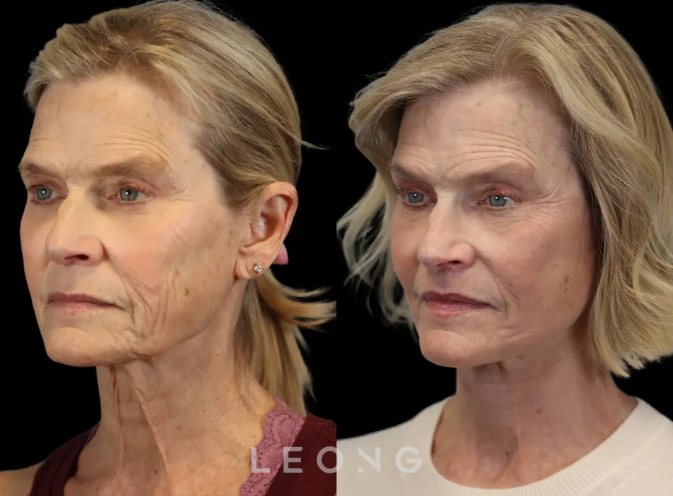 Facelift Before and After | Leong Facial Plastic Surgery