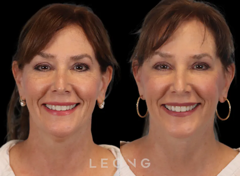 Facelift Before and After | Leong Facial Plastic Surgery