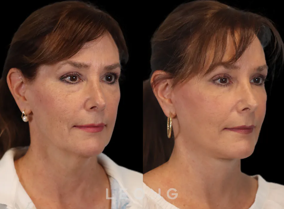 Facelift Before and After | Leong Facial Plastic Surgery