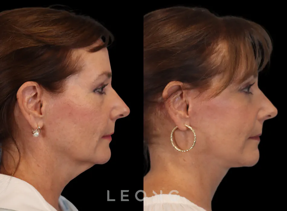Facelift Before and After | Leong Facial Plastic Surgery
