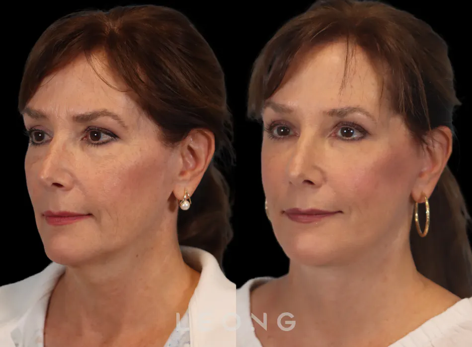 Facelift Before and After | Leong Facial Plastic Surgery