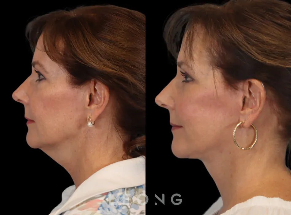 Facelift Before and After | Leong Facial Plastic Surgery