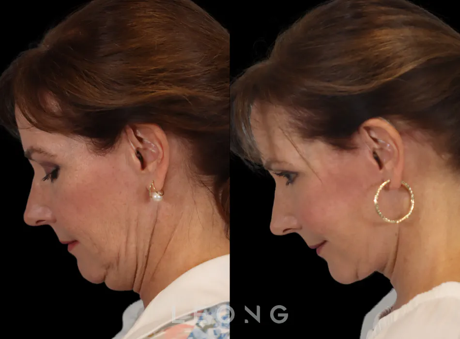 Facelift Before and After | Leong Facial Plastic Surgery