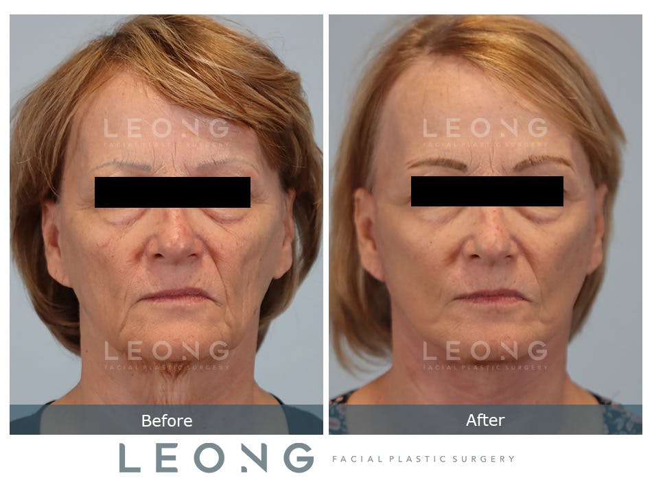 Facelift Before and After | Leong Facial Plastic Surgery