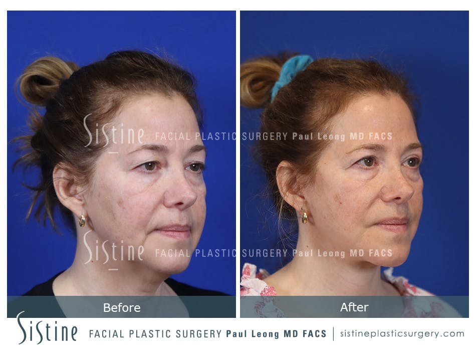 Facelift Before and After | Leong Facial Plastic Surgery