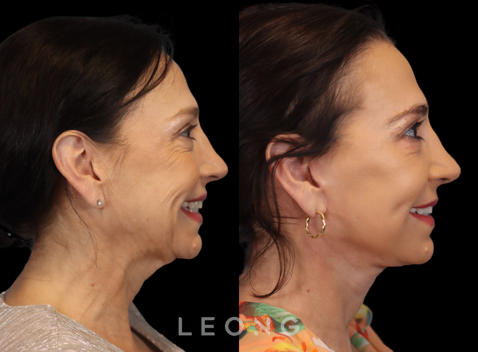 Facelift Before and After 06 | Leong Facial Plastic Surgery
