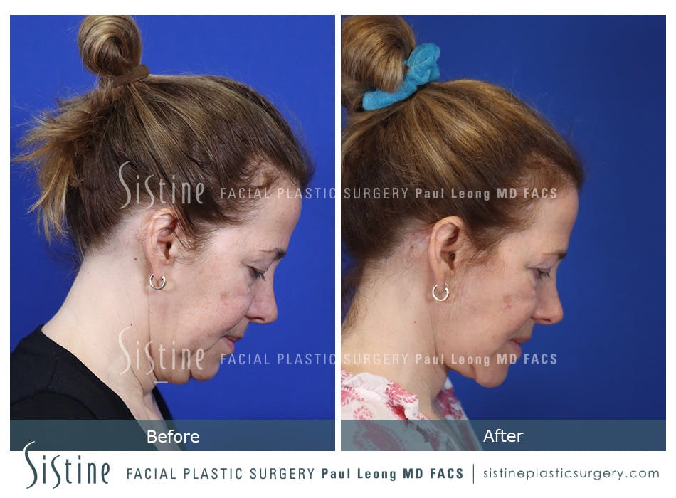 Facelift Before and After | Leong Facial Plastic Surgery