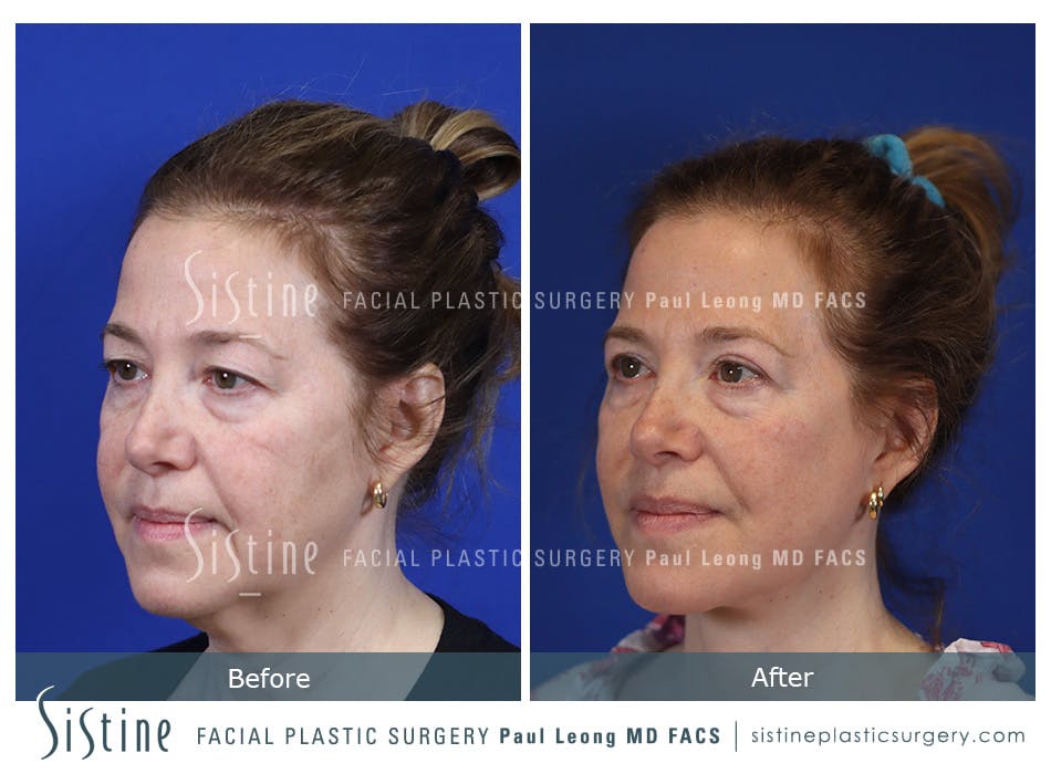 Facelift Before and After | Leong Facial Plastic Surgery