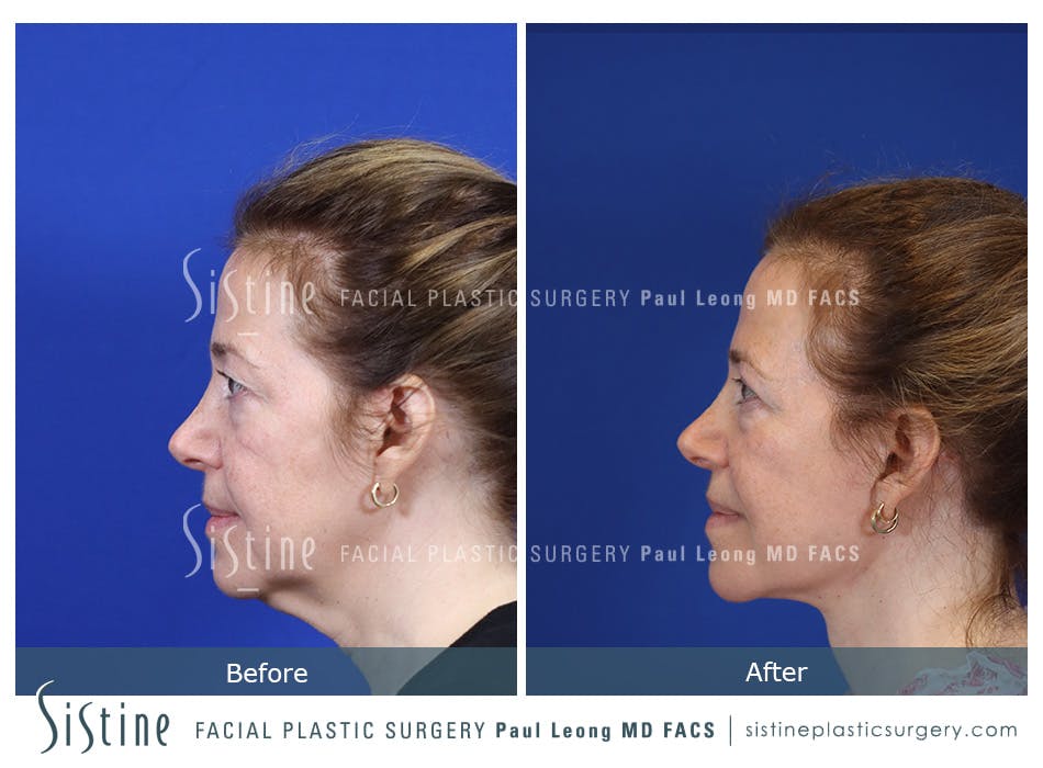 Facelift Before and After | Leong Facial Plastic Surgery