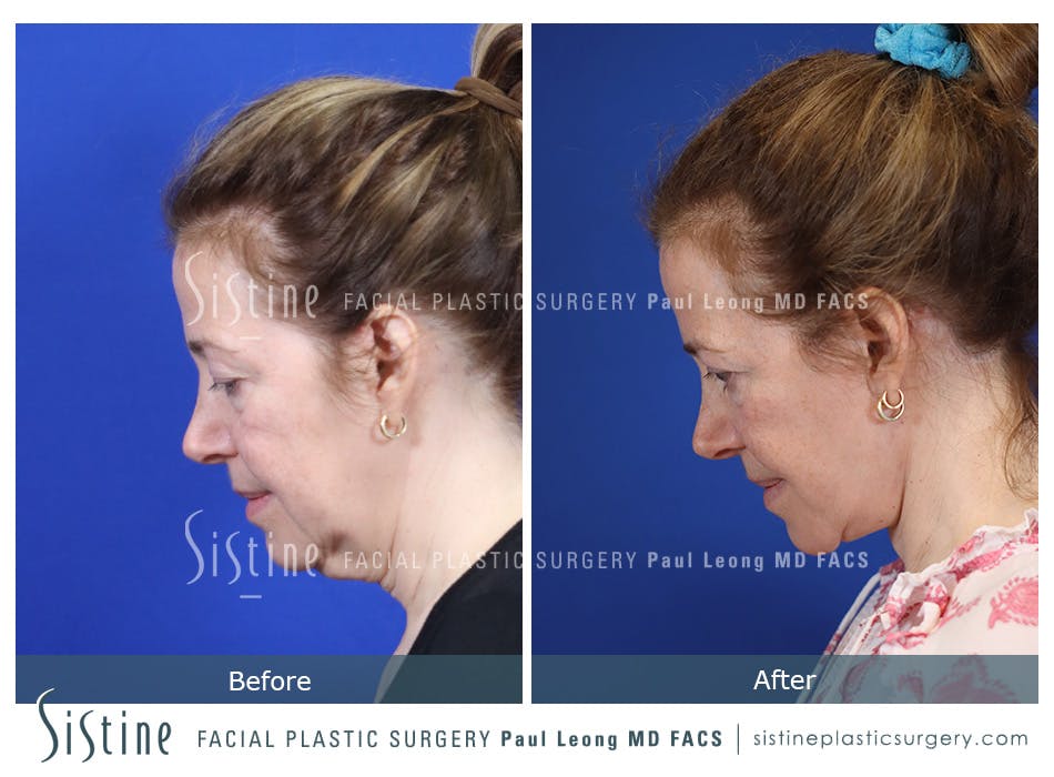 Facelift Before and After | Leong Facial Plastic Surgery
