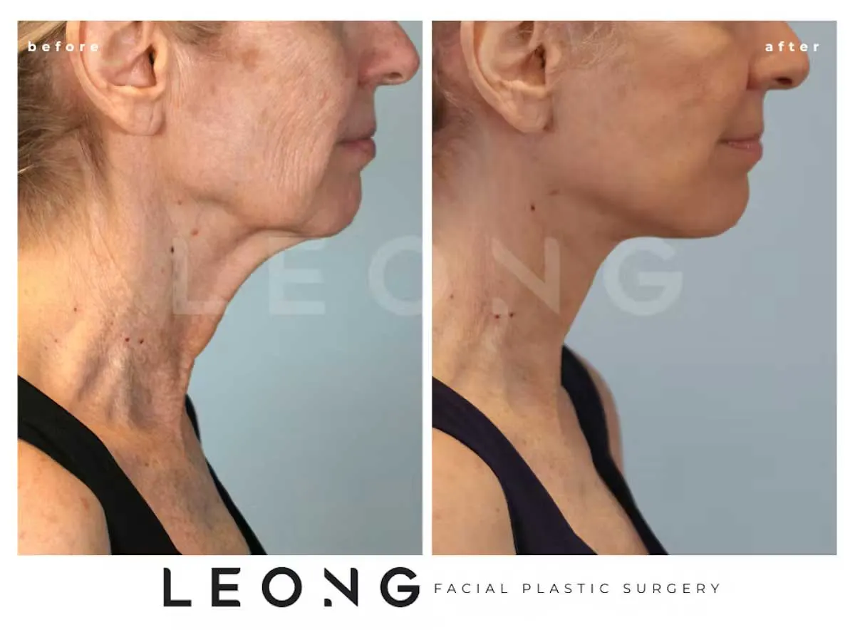 Facelift Before and After | Leong Facial Plastic Surgery