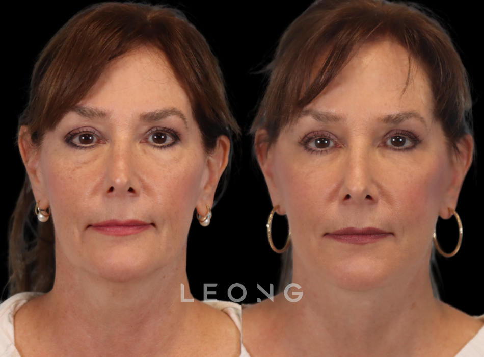Facelift Before and After 01 | Leong Facial Plastic Surgery