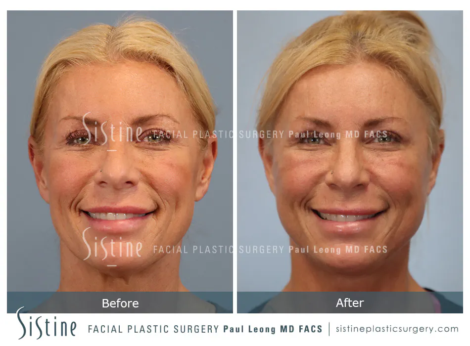 Facelift Before and After | Leong Facial Plastic Surgery