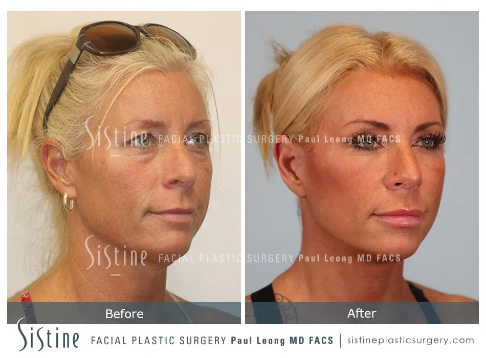 Facelift Before and After | Leong Facial Plastic Surgery
