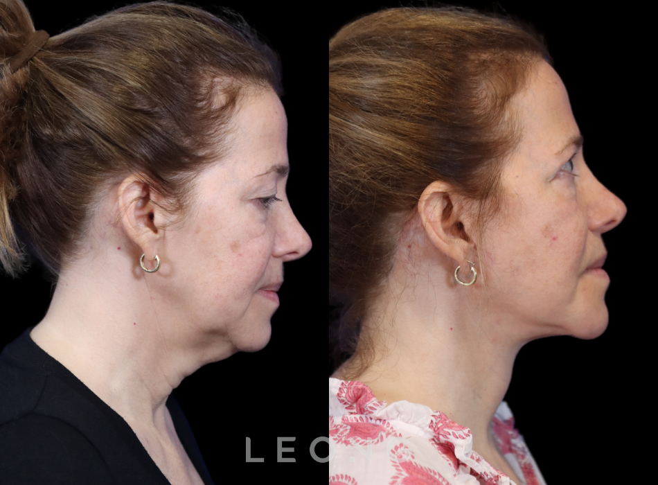 Facelift Before and After 07 | Leong Facial Plastic Surgery