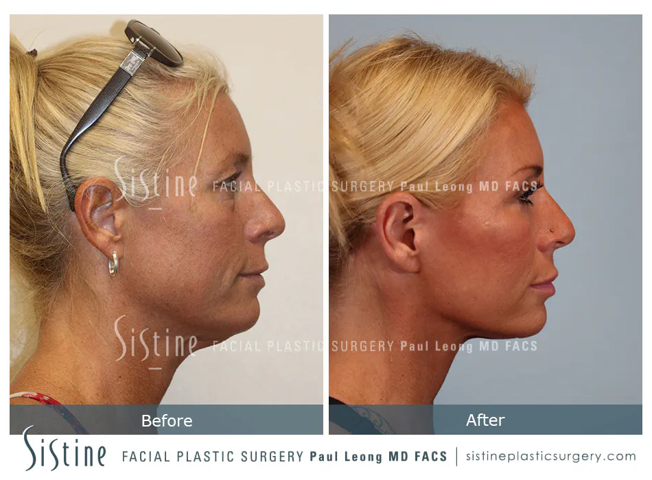 Facelift Before and After | Leong Facial Plastic Surgery