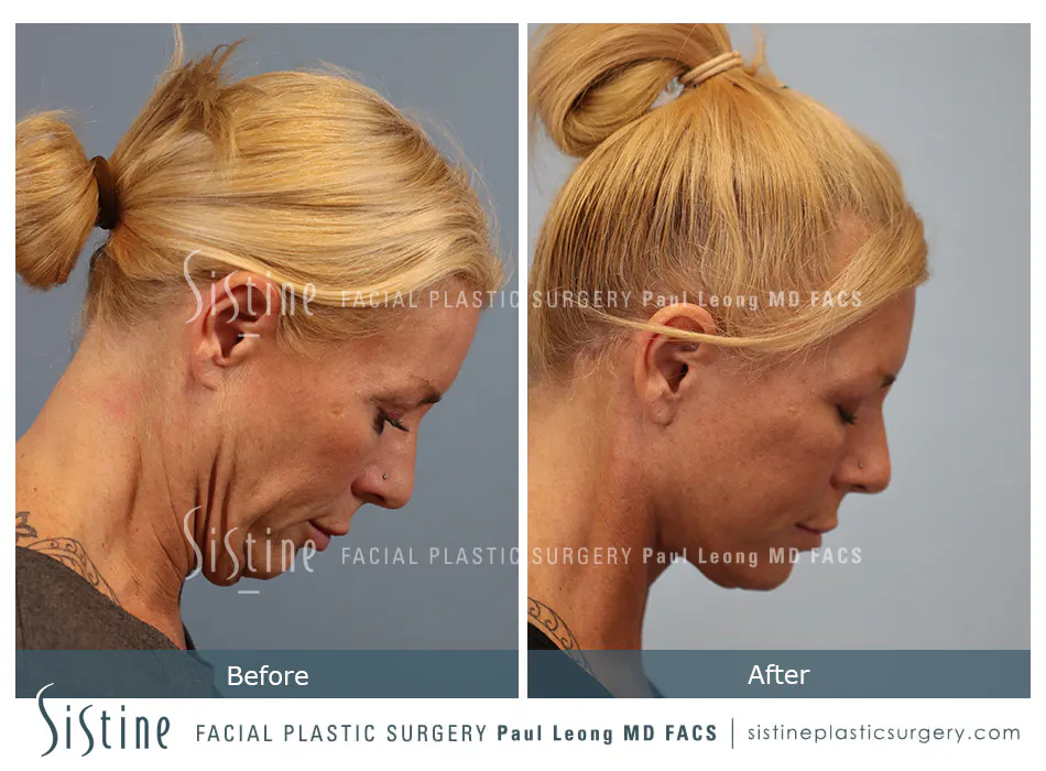 Facelift Before and After | Leong Facial Plastic Surgery
